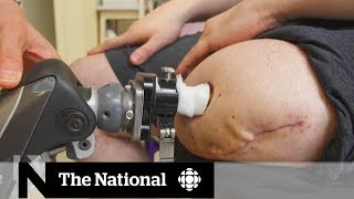 How a new surgical procedure is helping some amputees walk without pain [upl. by Nalyr288]