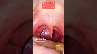 Tonsil Stones Removal Procedure All compilation [upl. by Zalea]