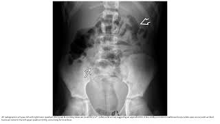 Appendicitis – bowel obstruction Imaging [upl. by Limhaj]