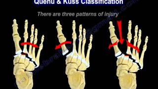 Lisfranc Injuries  Everything You Need To Know  Dr Nabil Ebraheim [upl. by Adias]