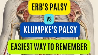 Erbs Palsy Vs Klumpkes Palsy  Brachial Plexus Injury  Easy Way To Remember [upl. by Drawyeh]