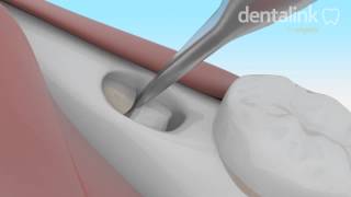 Exodoncia COMPLEJA tercer molar incluido  Video 3D paso a paso [upl. by Anillek]