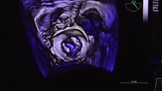 post rheumatic mitral valve stenosis [upl. by Tema595]