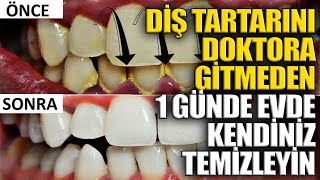 Diş Tartarını Doktora Gitmeden 1 Günde Evde Kendiniz Temizleyin [upl. by Esialb788]