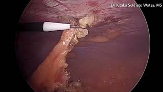 Laparoscopic Port site hernia repair [upl. by Divod]