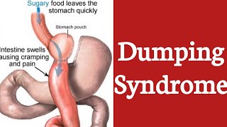 Dumping Syndrome  Early Dumping Syndrome  Late Dumping Syndrome [upl. by Keeley814]