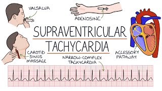 Understanding Supraventricular Tachycardia SVT [upl. by Andaira]