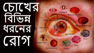 চোখের বিভিন্ন ধরনের রোগ এবং তাদের লক্ষণ16 type of Eye Diseases [upl. by Thayer553]