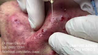 Dermatologistsqueeze pimpleswhitehead blackhead pustuleanti acnesVimpire acnes long video 2 [upl. by Nolahc935]