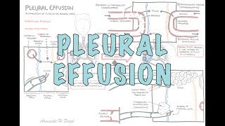 Pleural Effusion DETAILED  pathophysiology signs and symptoms treatment [upl. by Ahsirek]