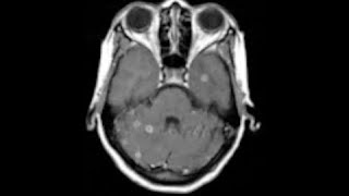 NEURORADIOLOGY CNS Infections  I  DEEPAK PATKAR  Tuberculomas vs Cysticercosis [upl. by Jay663]