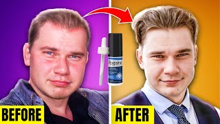 10 Year Rogaine Review Minoxidil IT WORKS [upl. by Aknaib]