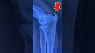 TRICEPS TENDON ENTHESOPATHY calcification triceps tendonitis shorts ytshorts trending viral [upl. by Downing58]