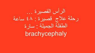 Brachycephaly correction [upl. by Ahseia111]