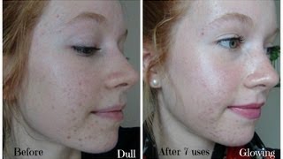 Personal Microderm Review PMD Demo and Before amp After Pictures [upl. by Ahsratal]