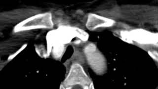 Gated CT Chest Angiography Bicuspid Aortic Valve [upl. by Zendah177]