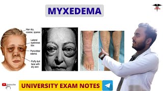 Myxedema  Hypothyroidism  Endocrine Physiology [upl. by Ainwat]