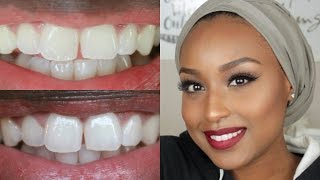 How I Whitened My Teeth At Home  Smile Brilliant ReviewampDemo ♡ [upl. by Phenica]