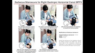 Barbecue Manoeuvre for Right Geotropic Horizontal Canal BPPV [upl. by Anirroc]