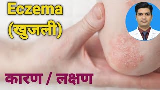 Eczema के कारण तथा लक्षण । Eczema causes and Symptoms [upl. by Zumstein]