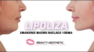 Lipoliza  Beauty Aesthetic Tuzla [upl. by Nodmac776]