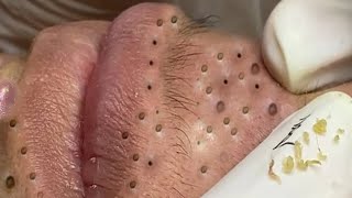 Big Cystic Acne Blackheads Extraction Blackheads amp Milia Whiteheads Removal Pimple Popping  3536 [upl. by Ria]