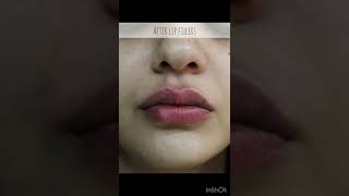 Lip Filler Before and After Compilation  LIP FILLER drjyotiguptadermatologist7266 Lip Injections [upl. by Ranip]