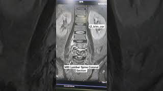 MRI Lumbar Spine Coronal Section t2trimcor Sequence Planning for beginners [upl. by Zeta]