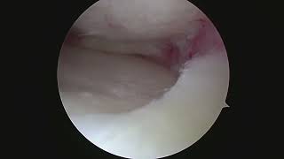 Knee Arthroscopy Partial Medial Meniscectomy Meniscus Surgery in a Patient with Mild Arthritis [upl. by Dnalwor112]