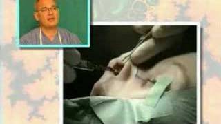 Estetska operacija nosa nose surgery Dr Glusac [upl. by Ramahs936]