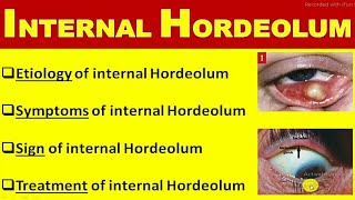 internal hordeolum [upl. by Justin584]