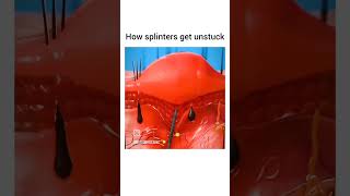 How splinters get unstuck  biology [upl. by Krueger826]