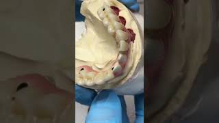 Now all in one to make one piece full mouth zirconia implants case [upl. by Carlick]