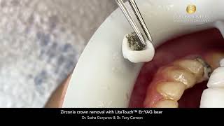 Zirconia crown removal with LiteTouch™ ErYAG laser [upl. by Burleigh453]