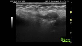 Bursitis PES Anserina [upl. by Ennayehc]