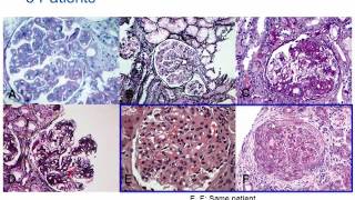 Understanding Membranoproliferative Glomerulonephritis Part 2 Hot Topic [upl. by Bail]