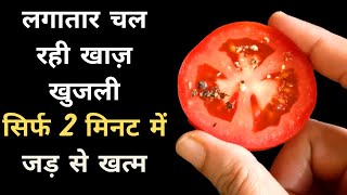 दाद खाजखुजली को जड़ से खत्म करने का 100 घरेलू उपाय  Natural way to get rid of itching  Khujli [upl. by Tad]