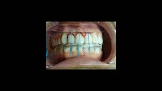 gingivectomyoralsurgeryperiodontalsurgery [upl. by Idolah732]