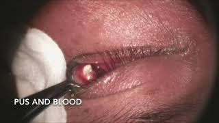 Incision and Drainage of Chalazion [upl. by Elak996]