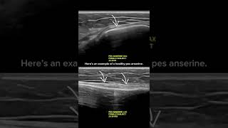 ultrasound Guided Interventions Healthy Images Pes Anserine [upl. by Volnay852]