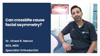 Can crossbite cause facial asymmetry [upl. by Ordnassela]