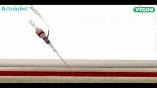 ArterioSel  Safe Simple Successful Arterial Cannulation [upl. by Greff]