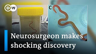 Neurosurgeon removes live worm from womans brain in worldfirst discovery  DW News [upl. by Dellora]