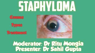 Staphyloma  Ophthalmology  For Medical Students [upl. by Acirretal]