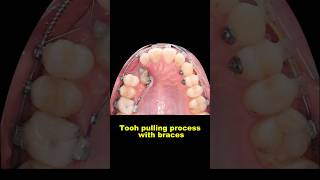 Pulling out hidden teeth when braces braces orthodontist dentist bracesoff [upl. by Hank]