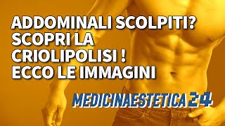 CRIOLIPOLISI ADDOME PRIMA E DOPO ecco le immagini [upl. by Ahtilat]