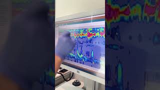 Esophageal Manometry Test with Austin Gastro November 2024 [upl. by Arit137]