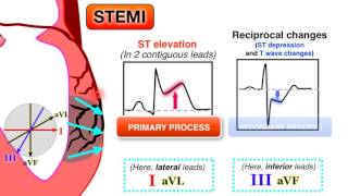 Ischemia 67  STEMI on ECG [upl. by Gould]