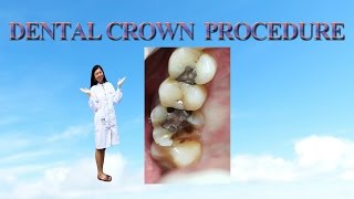 dental crown procedure [upl. by Eerb144]