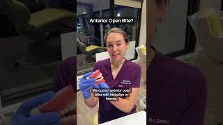 Anterior Open Bite [upl. by Humphrey]